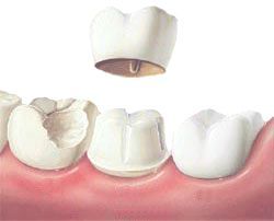 Dental Crown Procedure India